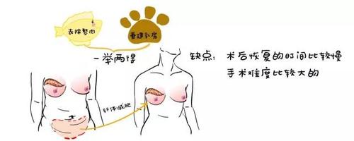 乳腺切除后整形(乳腺全切加整形)