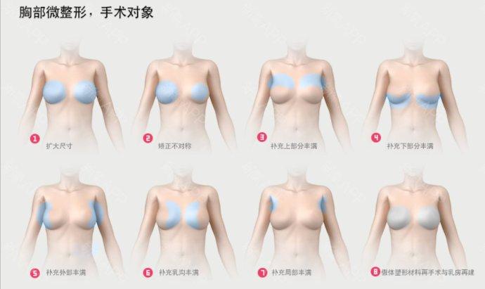 乳房整形自然吗(乳房整形需要多少钱)