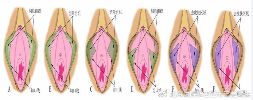 私密整形正常吗(私密整形有什么效果)